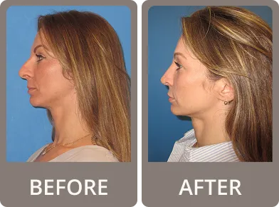Side-by-side before and after photos of a woman showing rhinoplasty results with a more refined nose profile and improved chin alignment.