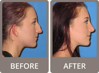 Side-by-side before and after photos of a woman showing a smoother, reshaped nose profile post-rhinoplasty against a blue background.