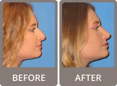 Side-by-side before and after photos of a woman showing profile changes following rhinoplasty, with a straighter nose and enhanced tip in the after image.