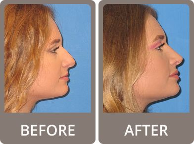 Side-by-side before and after photos of a woman showing profile changes following rhinoplasty, with a straighter nose and enhanced tip in the after image.