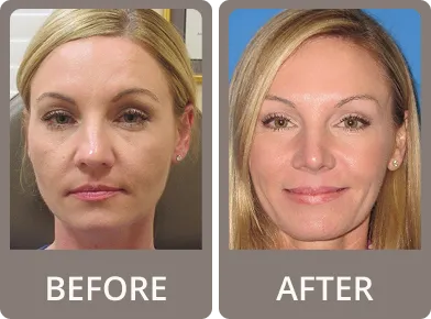 Side-by-side comparison of a woman's face before and after cosmetic rhinoplasty showing a smoother nose contour and subtle facial enhancements.