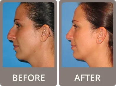 Side-by-side profile comparison of a woman before and after rhinoplasty, showing a straighter nose and refined chin in the after image.
