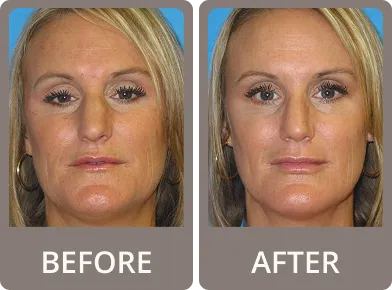 Side-by-side before and after photos of a woman showing improved skin texture and reduced facial redness after treatment.