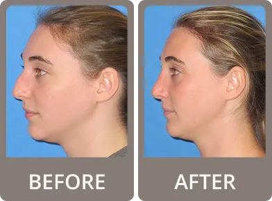 Side-by-side before and after profile images of a woman showing reduced nose size and improved chin definition after rhinoplasty and chin contouring.