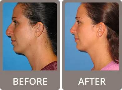 Side-by-side comparison of a woman's profile before and after rhinoplasty showing a reduced nasal hump and more refined nose shape.