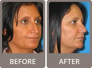 Side-by-side before and after images of a woman showing rhinoplasty results with a straighter nose profile.