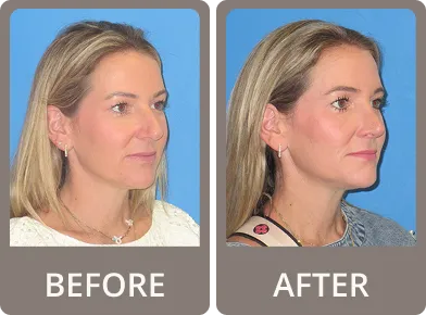 Side-by-side profile images of a woman labeled before and after rhinoplasty, showing a more refined nose shape in the after photo.