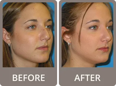 Side-by-side before and after photos of a woman's profile showing a noticeable rhinoplasty nose refinement.