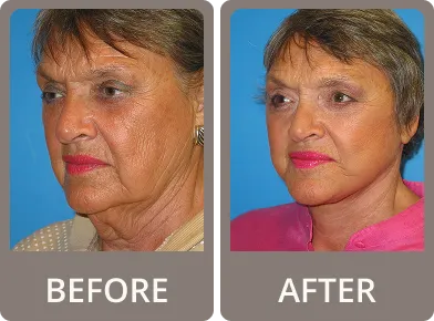 Side-by-side before and after photos of a woman showing eyelid rejuvenation results with lifted eyelids and smoother skin.