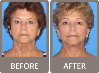 Side-by-side before and after photos of an older woman showing reduced facial wrinkles and a smoother complexion after eyelid rejuvenation.