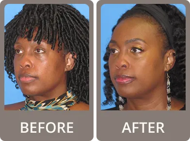 Before and after photos showing eyelid rejuvenation on a woman with darker skin; after image features brighter eyes and enhanced eyelashes.
