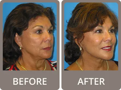 Side-by-side before and after photos of a woman showing smoother, lifted facial skin and enhanced makeup in the after image.