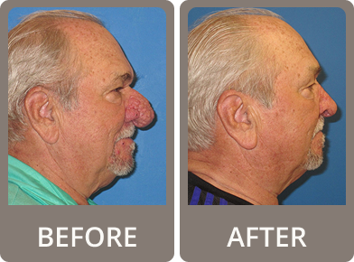 Side-by-side profile photos of an elderly man before and after surgery, showing removal of a large nasal growth.