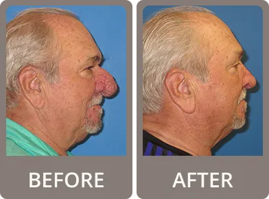 Side-by-side profile photos of an elderly man before and after surgery, showing removal of a large nasal growth.
