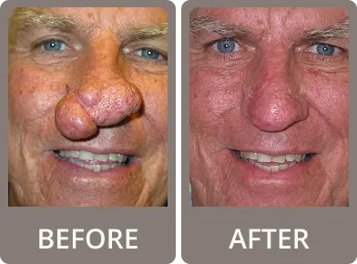 Side-by-side close-up comparison of a man's face before and after nasal reconstructive surgery, showing removal of enlarged growths on the nose.