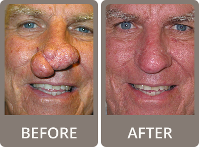 Side-by-side close-up comparison of a man's face before and after nasal reconstructive surgery, showing removal of enlarged growths on the nose.