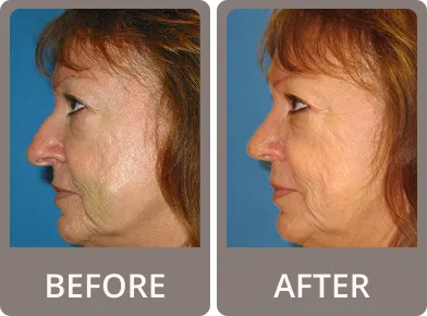 Side-by-side before and after profile images of a middle-aged woman showing a smoother and more refined nose after rhinoplasty.