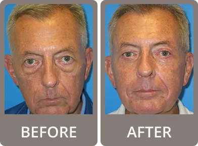 Side-by-side before and after photos of a man showing reduced under-eye bags and puffiness.