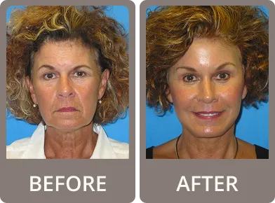 Side-by-side before and after images of an older woman showing reduced wrinkles and smoother skin after cosmetic treatment.