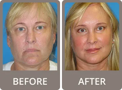 Side-by-side before and after photos of a woman's face showing subtle eyelid rejuvenation with less drooping skin.