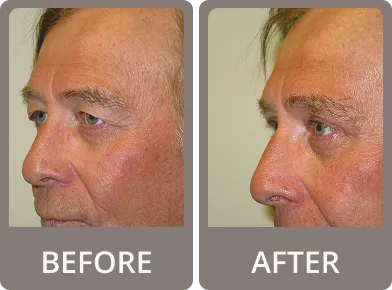 Side-by-side before and after images of a man's face showing reduced eyelid drooping and smoother skin after eyelid rejuvenation treatment.