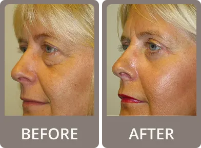 Side-by-side comparison of a woman's face before and after eyelid rejuvenation, showing reduced under-eye bags and smoother skin after treatment.