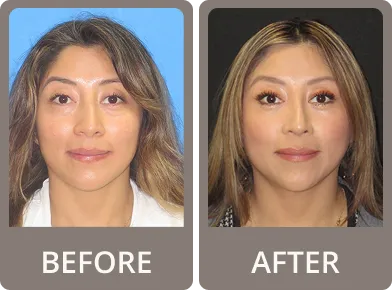 Side-by-side before and after photos of a woman showing subtle eyelid rejuvenation, with smoother upper eyelids in the after photo.