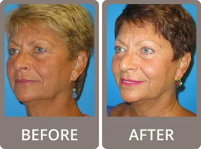 Side-by-side before and after photos of a middle-aged woman showing smoother eyelids and reduced wrinkles around the eyes after rejuvenation treatment.