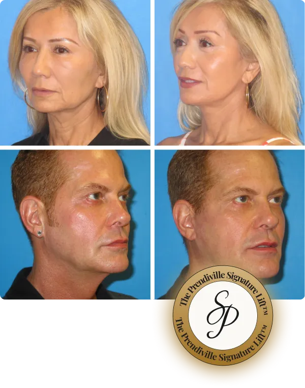 Side-by-side before and after photos of a woman and a man showing facial improvements from The Prendiville Signature Lift procedure.