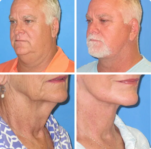 Before and after photos showing improved neck and jawline contouring in an older man and woman with reduced sagging skin.