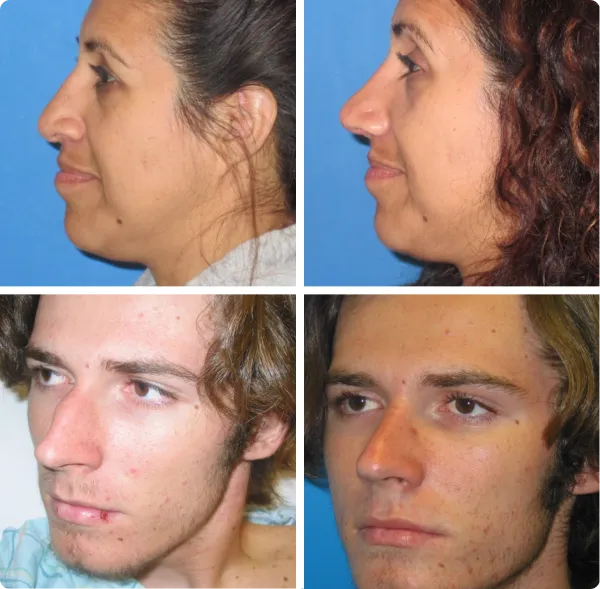 Before and after profile views of a woman showing nose and chin improvement, and before and after angled views of a young man with clearer facial skin and refined features.
