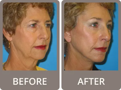 Side-by-side before and after photos of a man's face showing reduced puffiness and smoother skin around the eyes after cosmetic treatment.