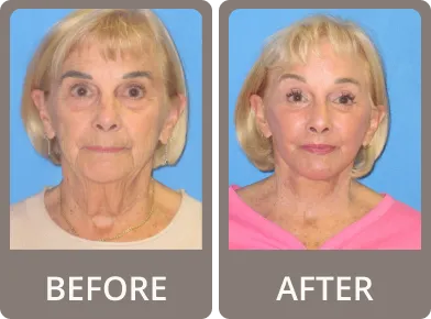 Side-by-side before and after photos of a woman showing facial rejuvenation with smoother skin and a more lifted appearance in the after image.