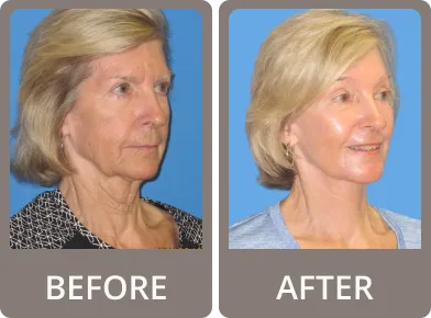 Side-by-side comparison of a woman’s face before and after treatment showing reduced under-eye puffiness and smoother skin.