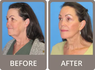 Side-by-side close-up images of a person's eye area labeled before and after, showing reduced under-eye puffiness in the after image.