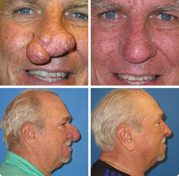 Before and after photos of an elderly man showing rhinophyma condition on the nose pre and post reconstructive surgery with frontal and side views.
