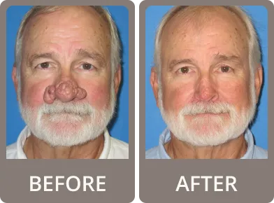 Side-by-side before and after photos of an older man showing a slimmer neck and added white beard in the after image.