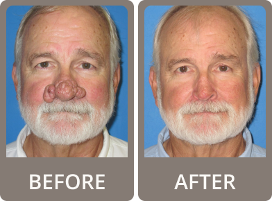 Side-by-side before and after photos of an older man showing a slimmer neck and added white beard in the after image.