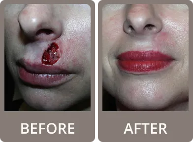 Side-by-side before and after photos of a blonde woman showing reduced wrinkles and smoother skin after facial rejuvenation.