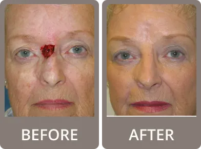 Side-by-side before and after images of an elderly woman showing smoother, tighter skin and reduced wrinkles after facial rejuvenation.