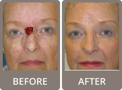 Side-by-side before and after images of an elderly woman showing smoother, tighter skin and reduced wrinkles after facial rejuvenation.