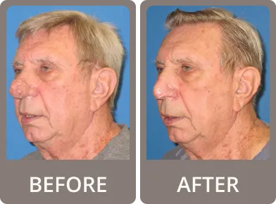 Side-by-side before and after images of a middle-aged woman showing facial rejuvenation with smoother skin and a more youthful appearance in the after photo.