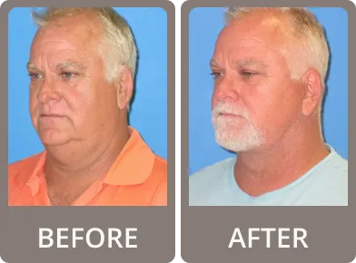 Side-by-side comparison of a woman before and after treatment, showing tightened and smoother skin under the chin and neck.