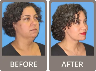 Side-by-side before and after photos of an older woman’s neck and jawline, showing reduced wrinkles and tighter skin in the after image.
