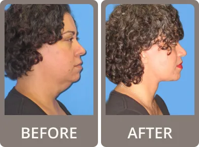 Side-by-side before and after photos of an older woman’s neck and jawline, showing reduced wrinkles and tighter skin in the after image.