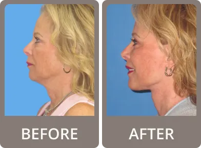 Side-by-side before and after photos of an older woman’s neck and jawline, showing reduced wrinkles and tighter skin in the after image.
