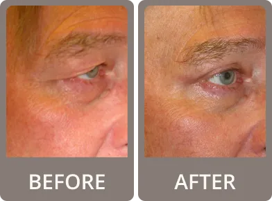 Side-by-side before and after photos of a middle-aged woman showing smoother eyelids and reduced wrinkles around the eyes after rejuvenation treatment.