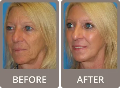 Side-by-side before and after photos of a middle-aged woman showing smoother eyelids and reduced wrinkles around the eyes after rejuvenation treatment.