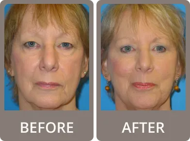 Side-by-side before and after photos of a middle-aged woman showing smoother eyelids and reduced wrinkles around the eyes after rejuvenation treatment.