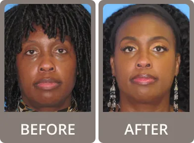 Before and after photos showing eyelid rejuvenation on a woman with darker skin; after image features brighter eyes and enhanced eyelashes.